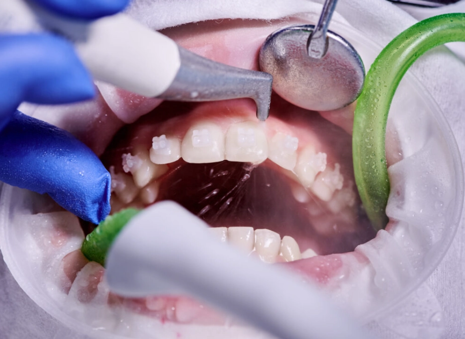 quick teeth cleaning