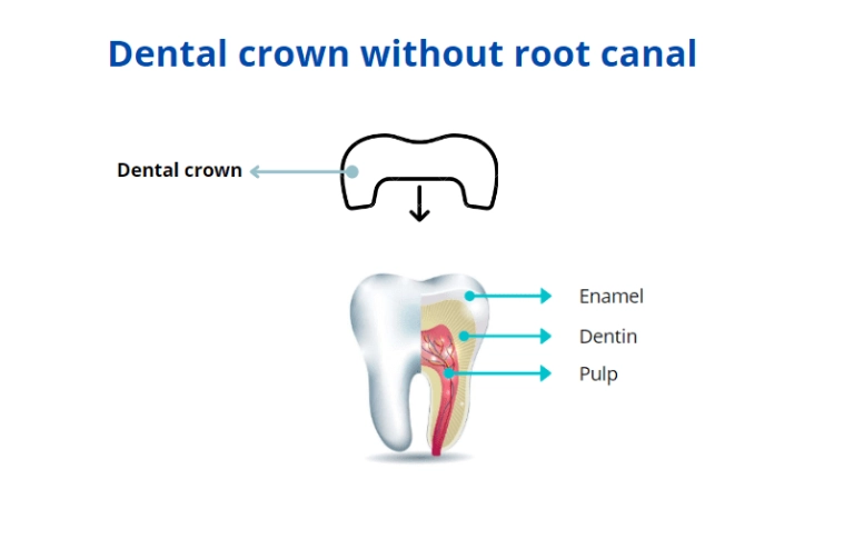 What Does a Tooth Look Like After a Root Canal Without a Crown?