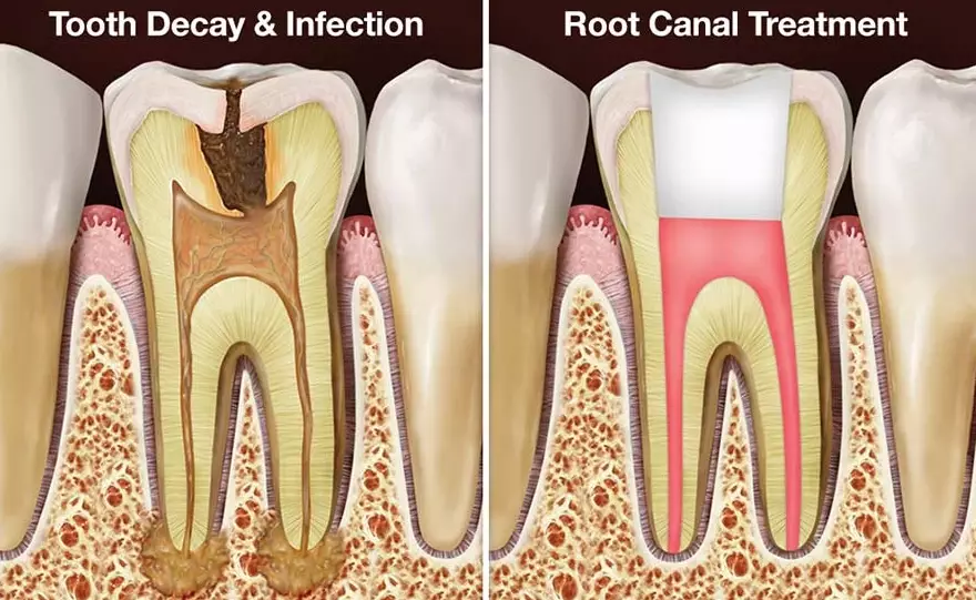 Will My Tooth Look Different After a Root Canal? Here's What to Expect