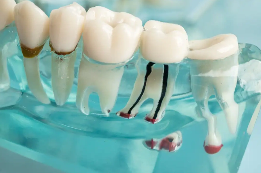 front tooth root canal appearance