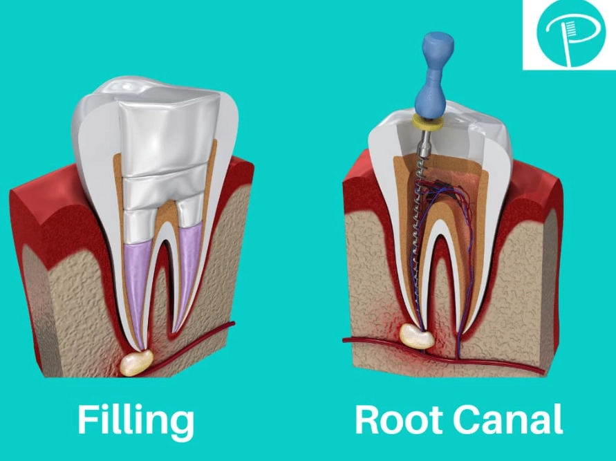 root canal without crown root canal without crown