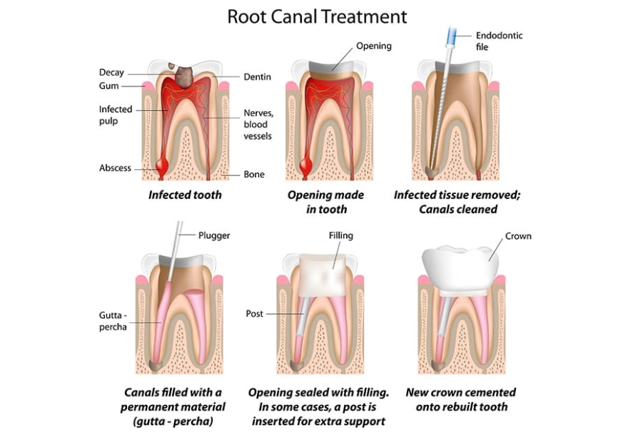 Early Warning Signs You Might Need a Root Canal