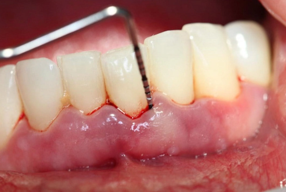 does scaling hurt does scaling hurt