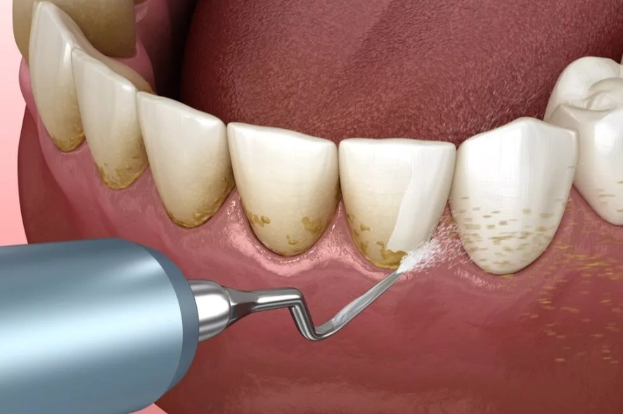 sensitive teeth cleaning