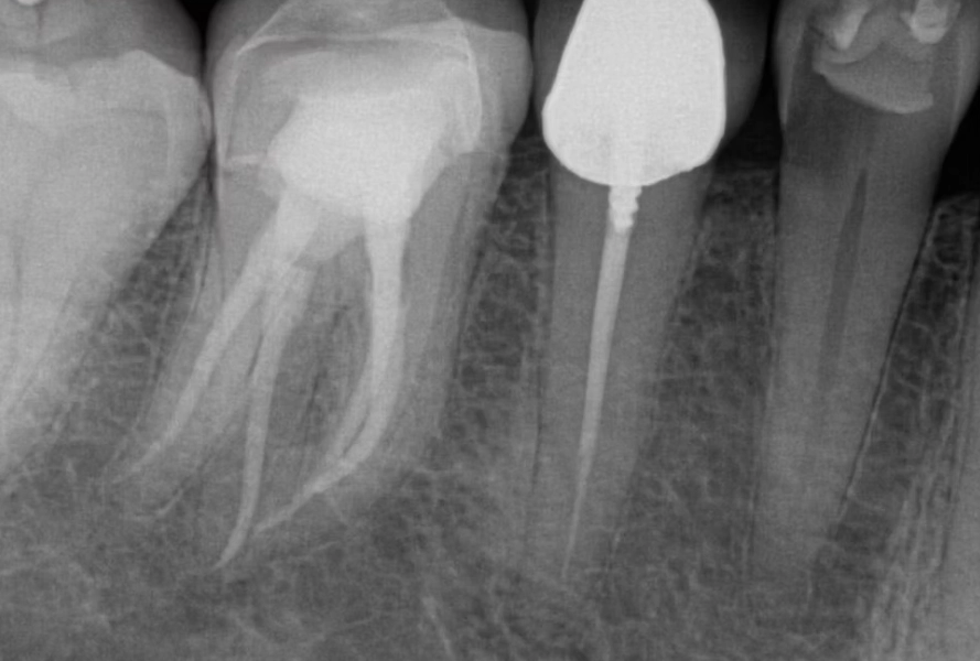 Root canal premolar