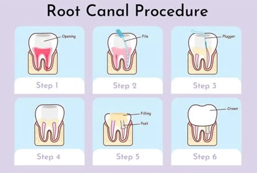 cost of root canal on molar