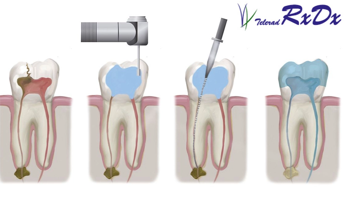 how long for a root canal how long for a root canal