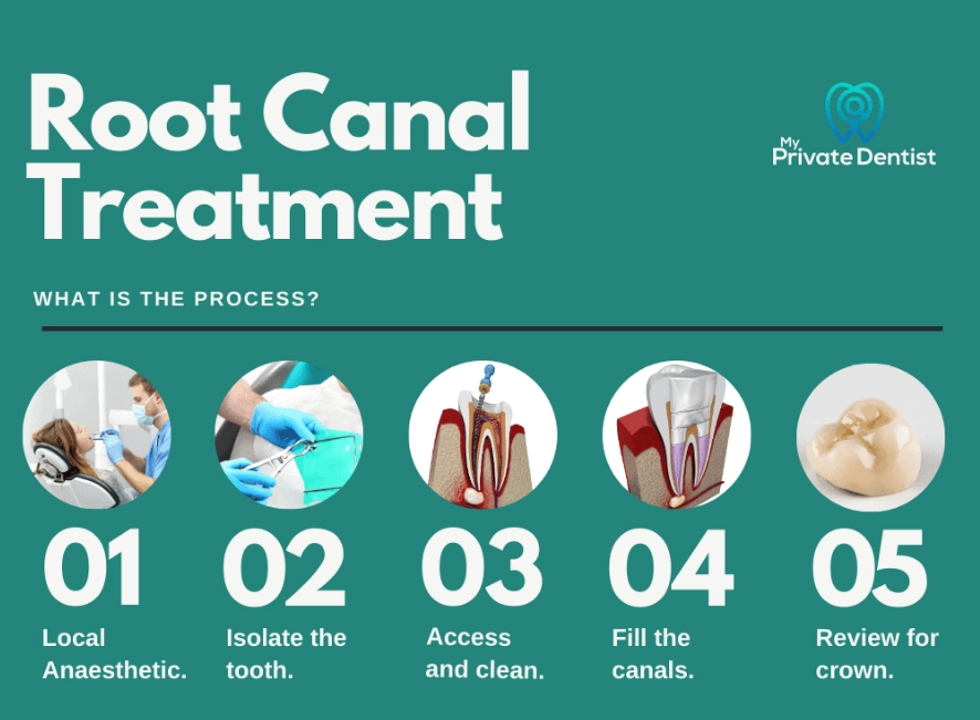 root canal duration root canal duration