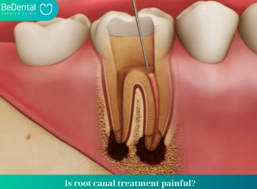 molar root canal cost