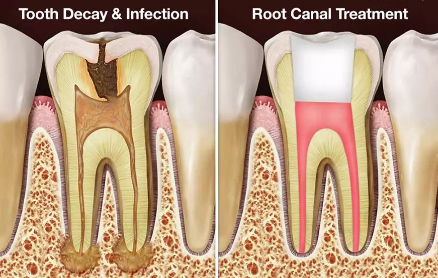 root canal on molar