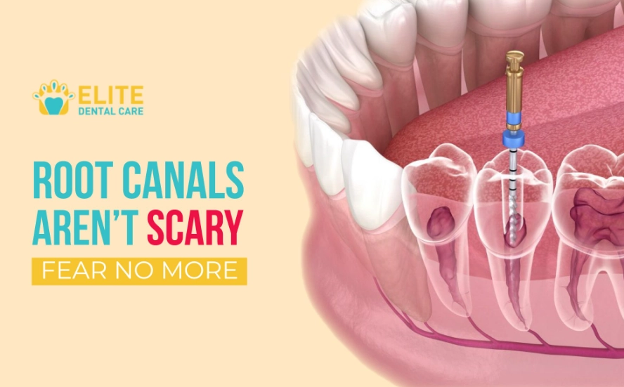 is a root canal worth it