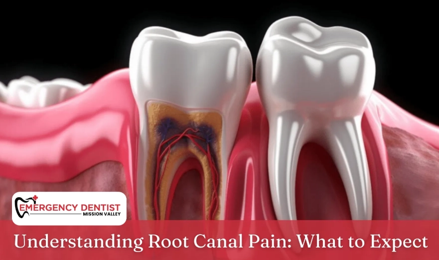 root canal pain root canal pain