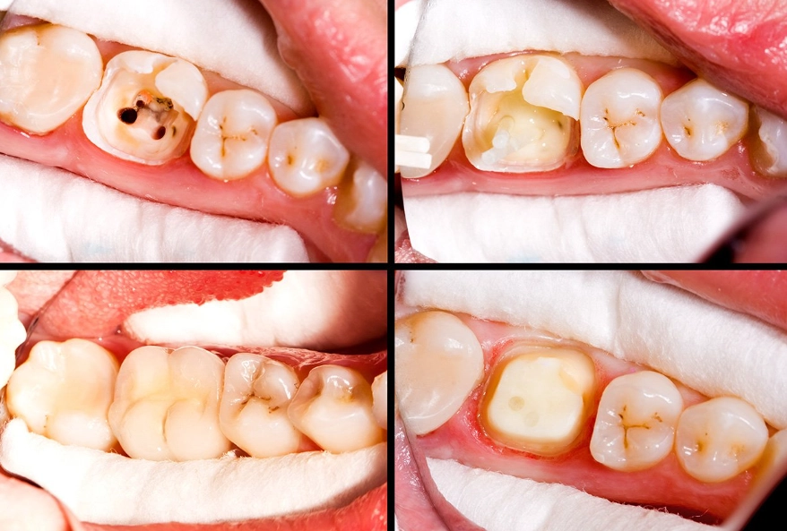 root canal procedure