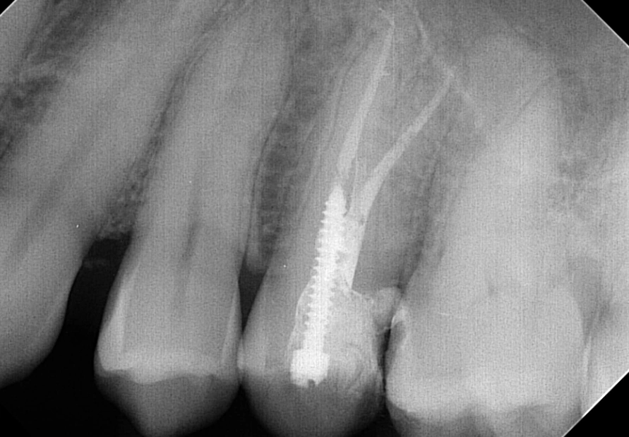 root canal procedure