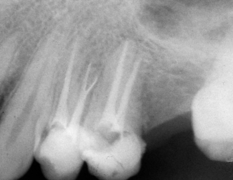 root canal cost