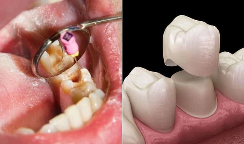 cost of root canal on molar