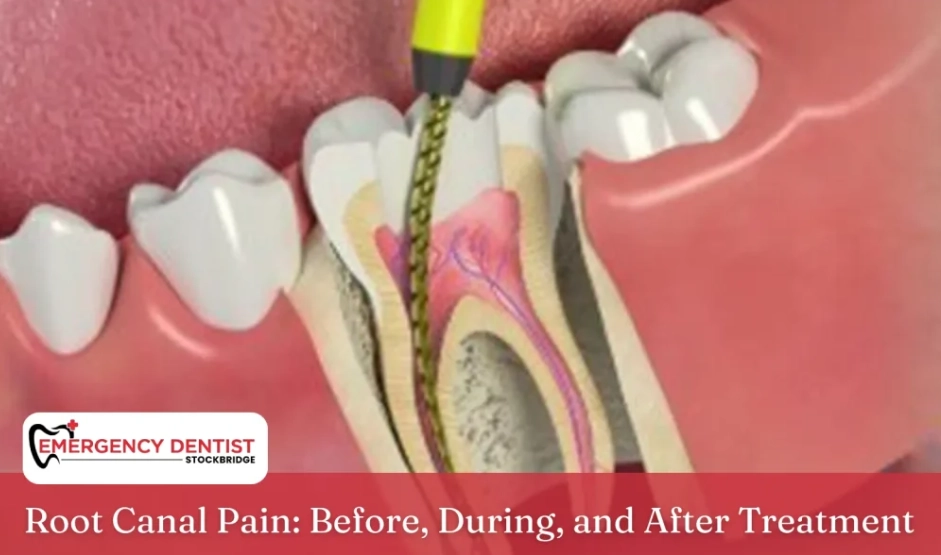 Is root canal treatment painful