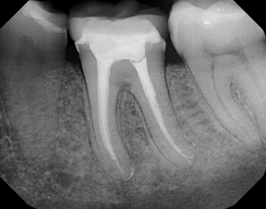 premolar root canal