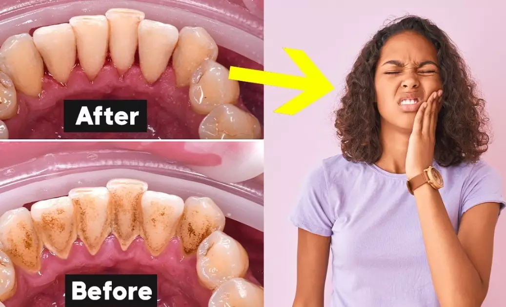 Teeth cleaning 4 times a year