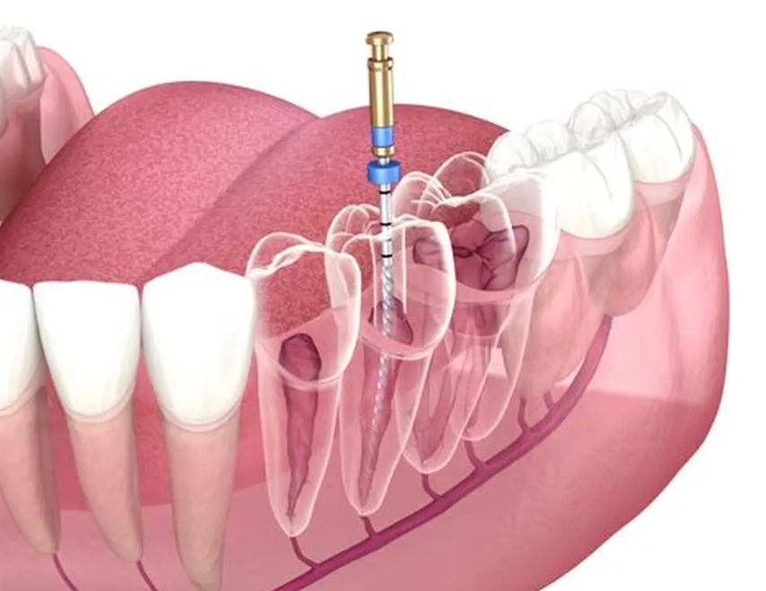 natural tooth decay reversal
