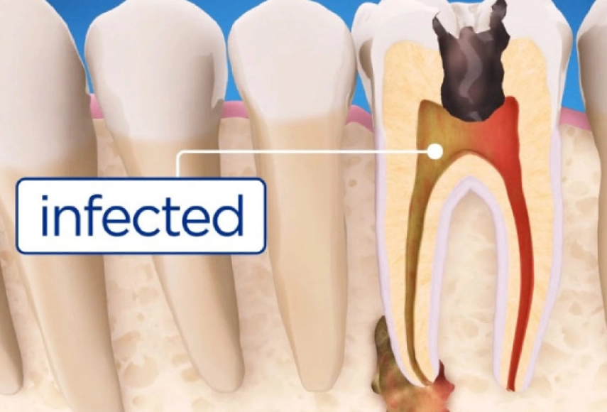 tooth pain early signs