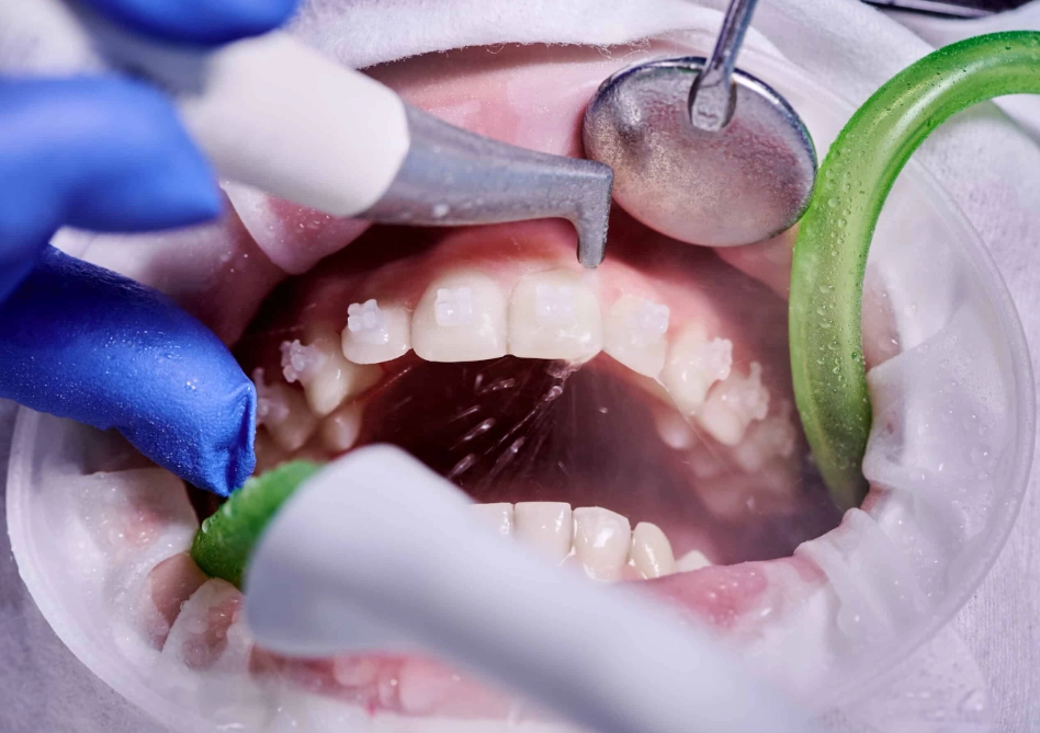 teeth cleaning frequency