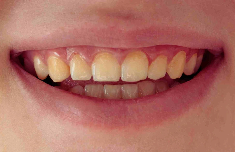teeth still yellow after whitening strips