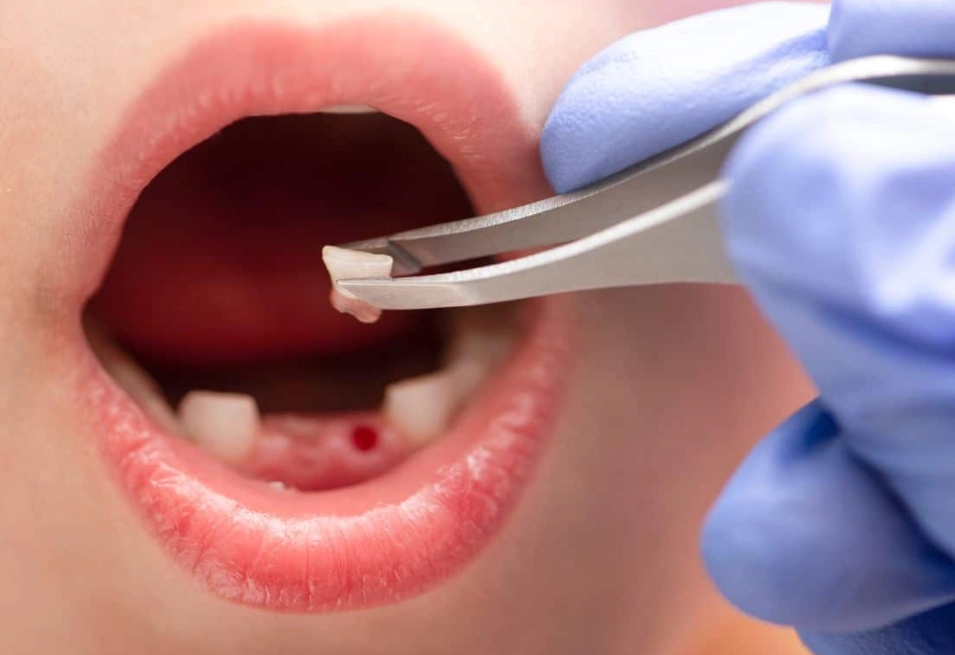 home remedies for toothache