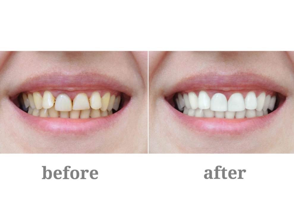 teeth still yellow after whitening strips