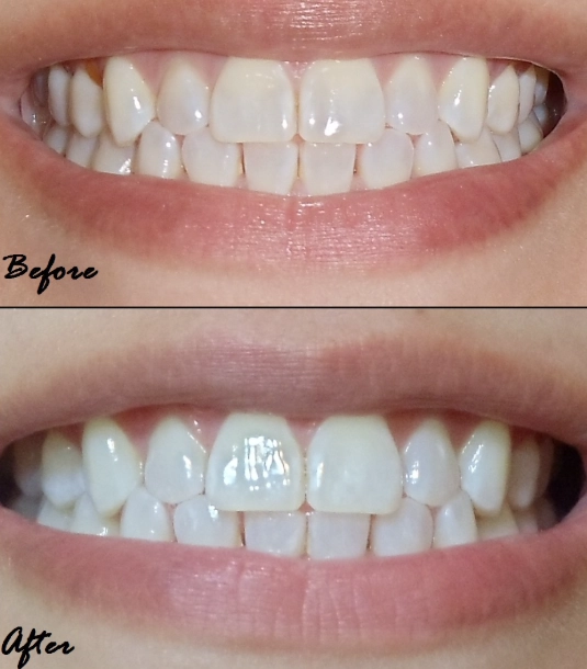 teeth whitening strips effectiveness teeth whitening strips effectiveness