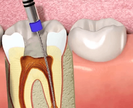 Root canal recovery time