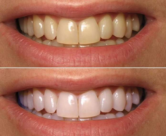 teeth whitening strips effectiveness teeth whitening strips effectiveness
