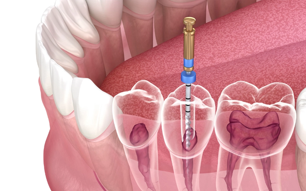 root canal recovery tips