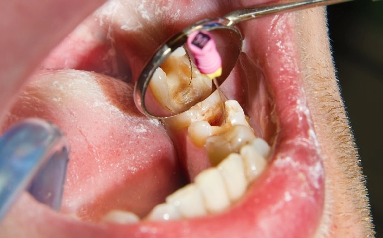 how long does a root canal take to heal
