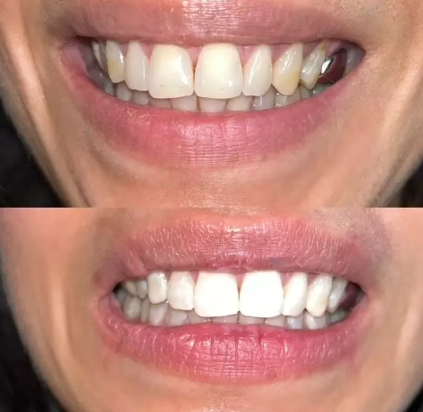 teeth whitening teeth whitening