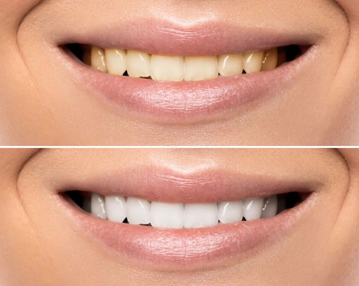 white teeth at home white teeth at home