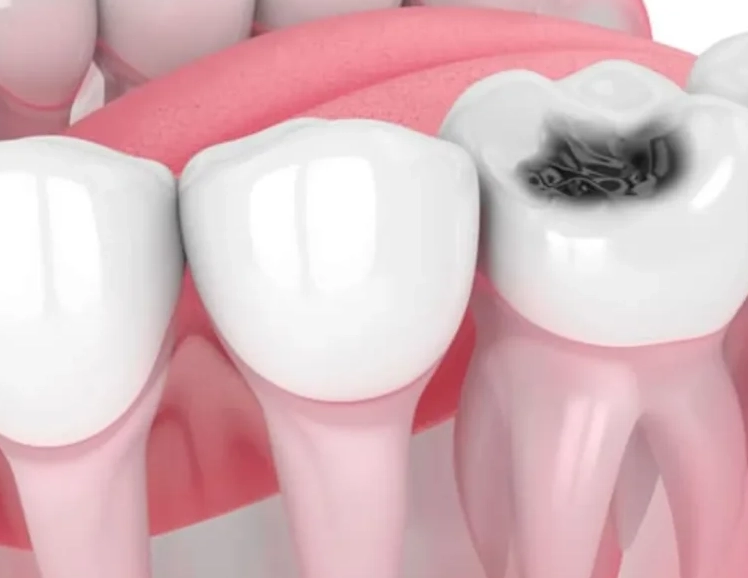 symptoms of root canal symptoms of root canal