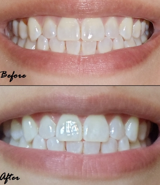 how long do crest whitening strips take to work how long do crest whitening strips take to work