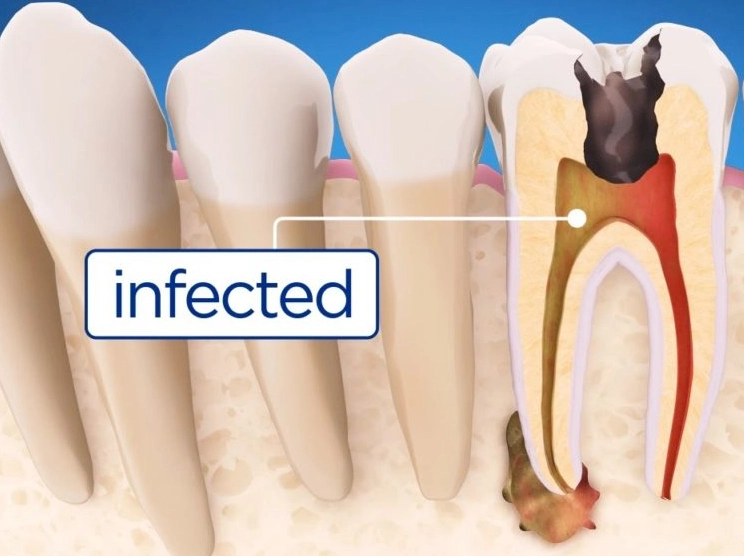 symptoms of root canal symptoms of root canal