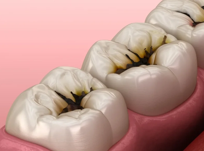 deep tooth decay deep tooth decay