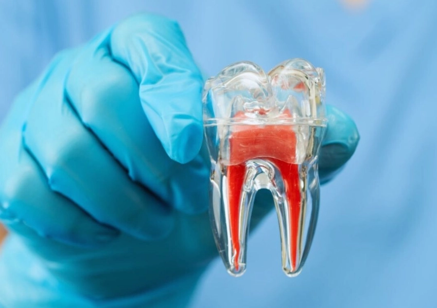 What causes root canal