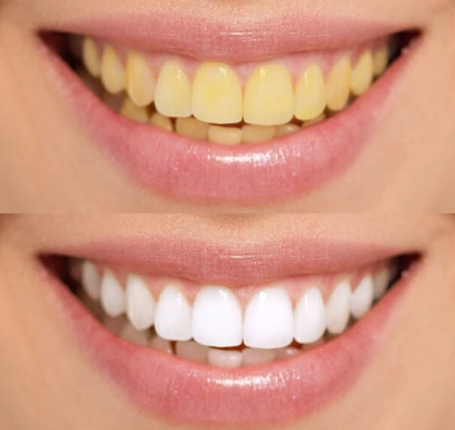 How can I whiten my teeth naturally?