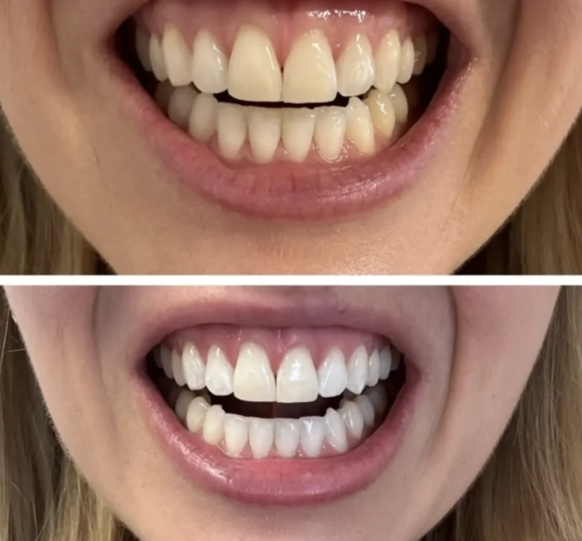 home remedies for white teeth home remedies for white teeth