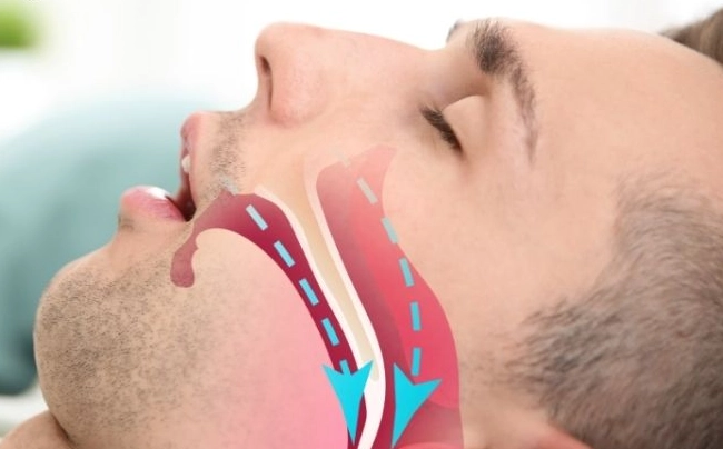 teeth grinding mouth guard teeth grinding mouth guard