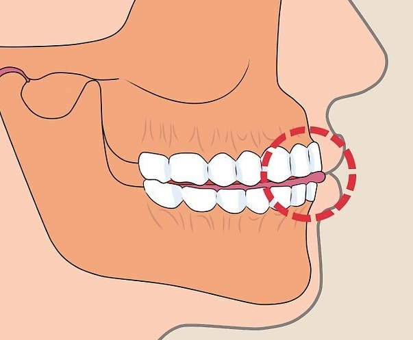 stop clenching teeth at night stop clenching teeth at night