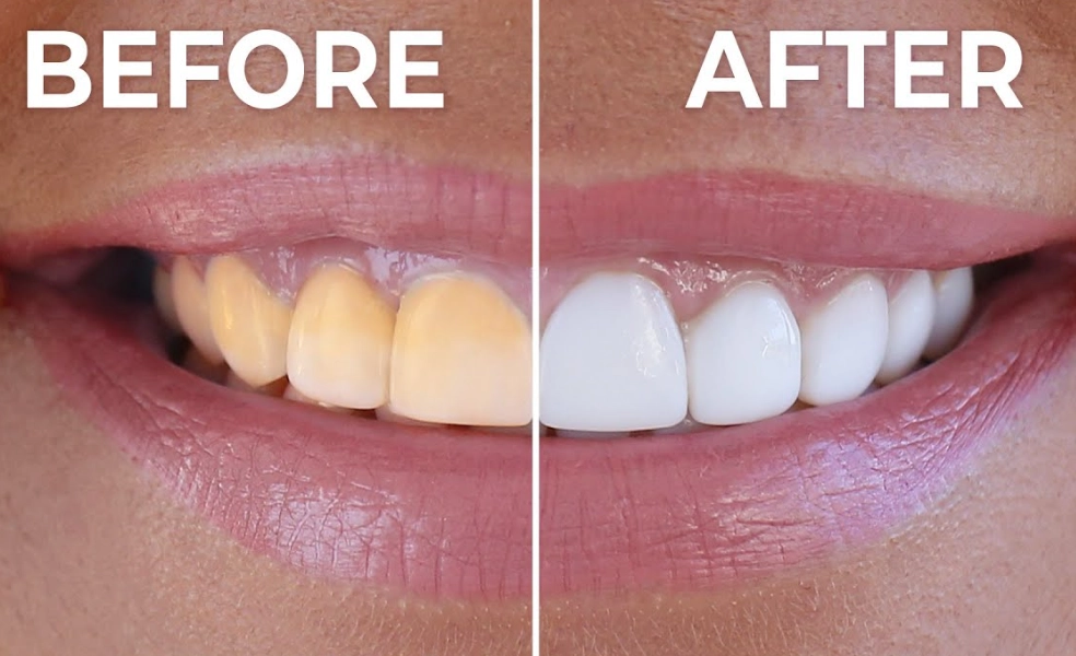 How to make your teeth white at home without baking soda