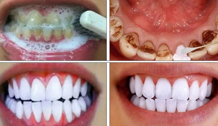 natural teeth whitening natural teeth whitening