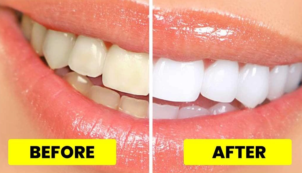 quick teeth whitening quick teeth whitening