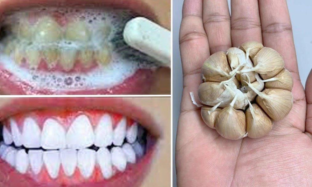 How to make teeth whiter in 3 minutes