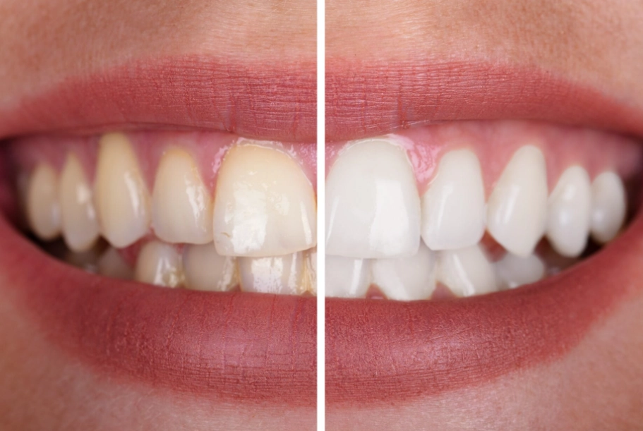 3 minute teeth whitening 3 minute teeth whitening